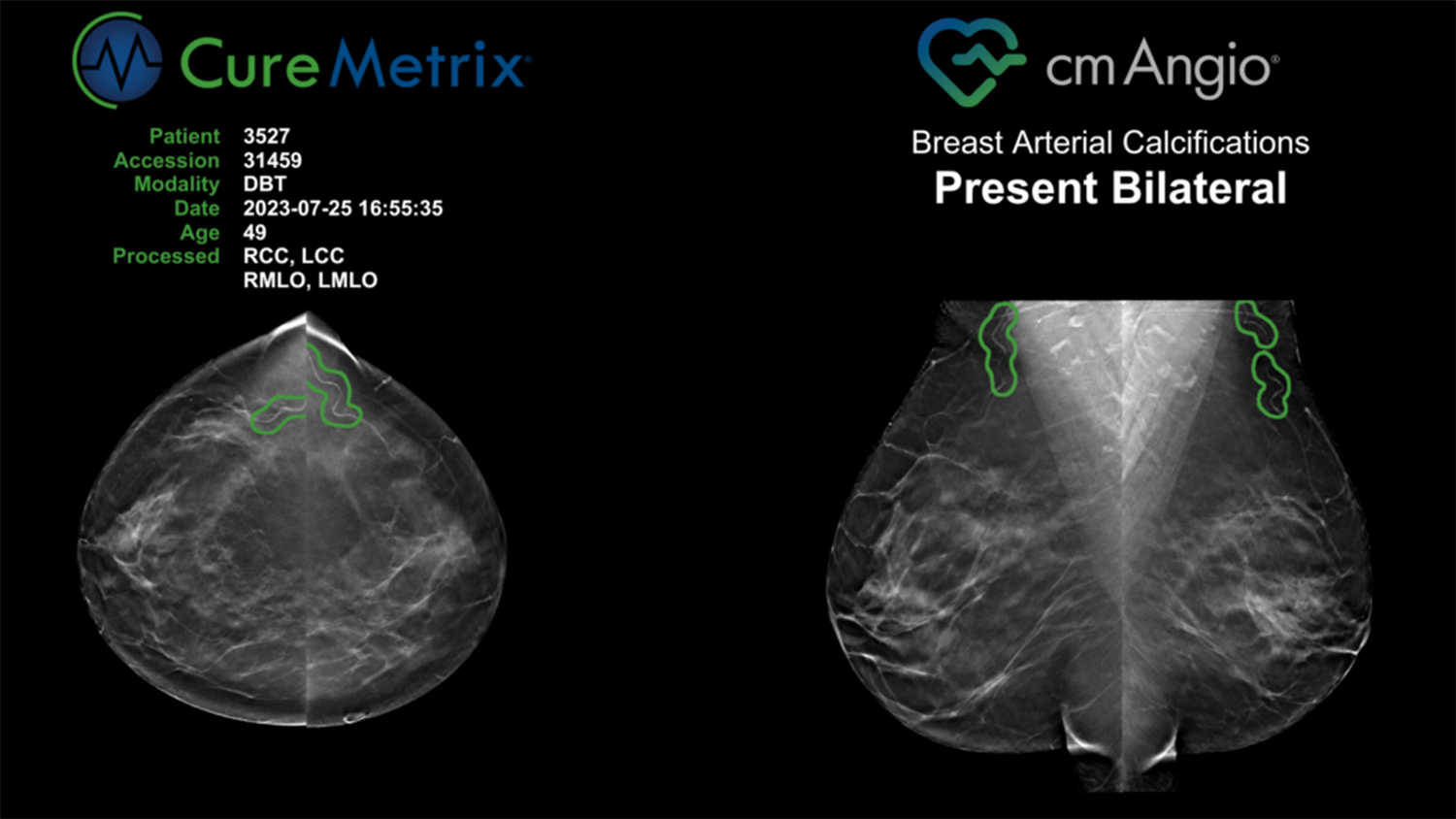 A shot of the cmAngio product identifying Breast Arterial Calcifications